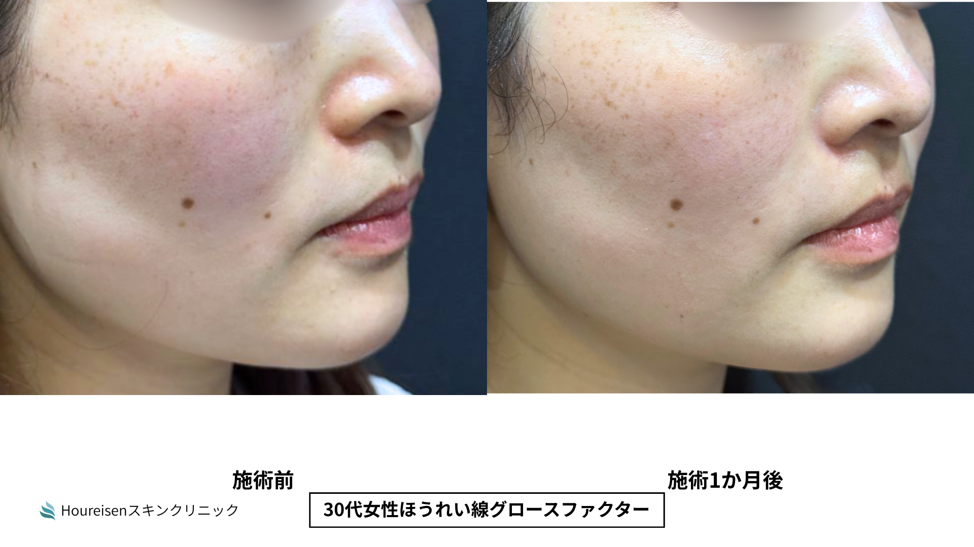 ほうれい線治療 症例比較