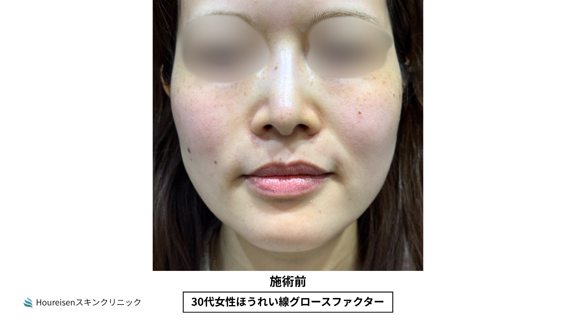 ほうれい線施術前