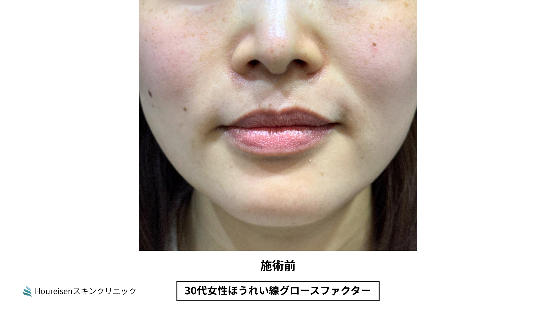 ほうれい線施術前