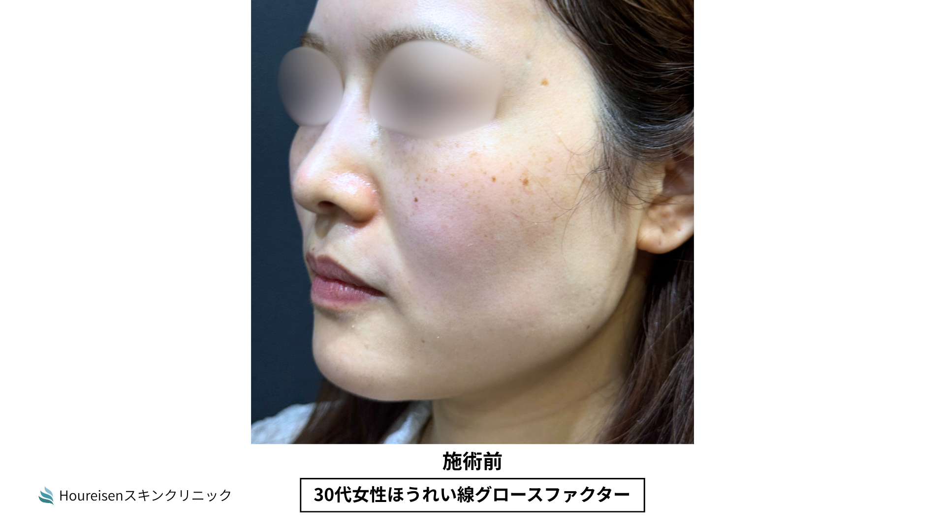 ほうれい線施術前