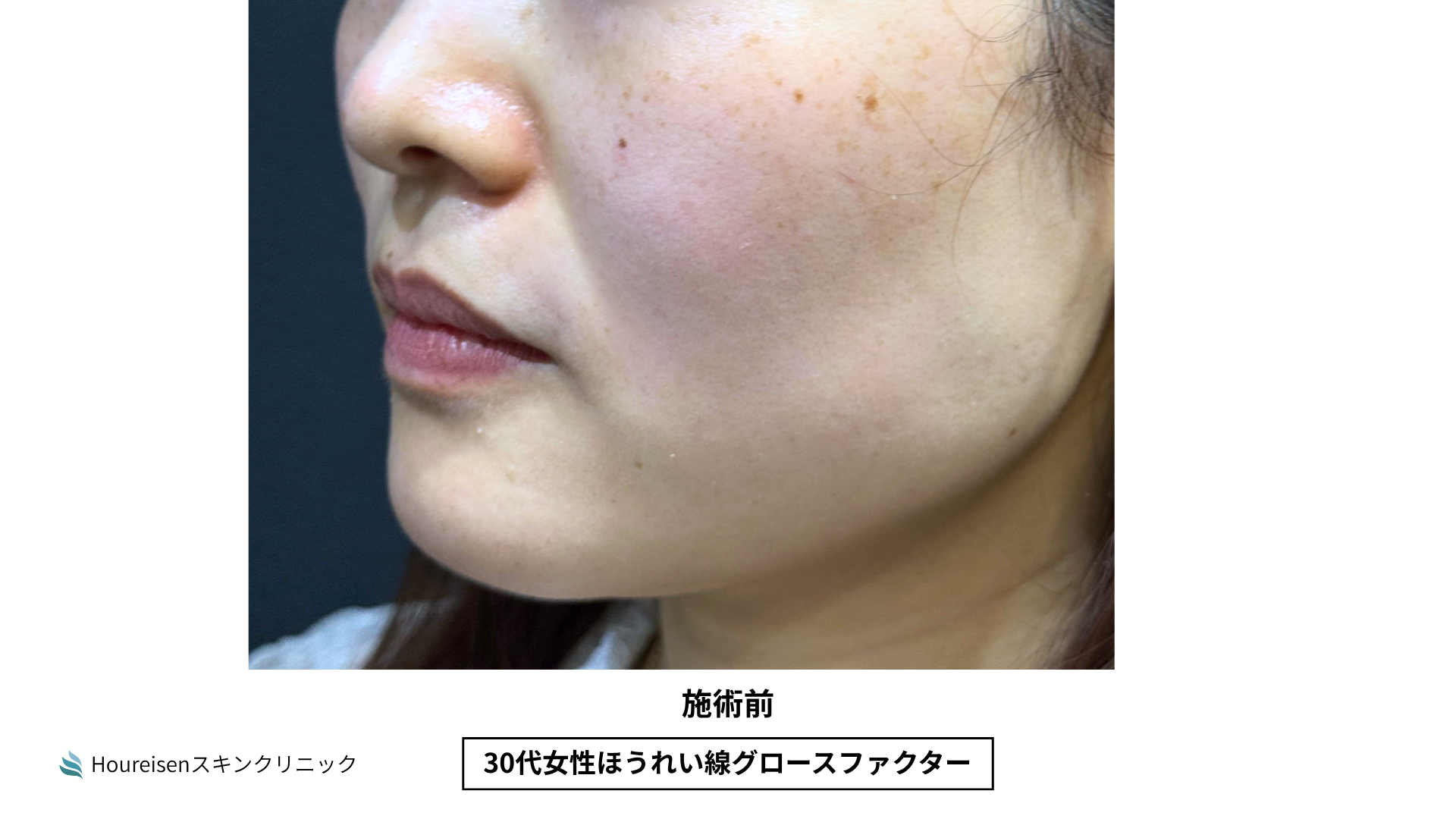 ほうれい線施術前