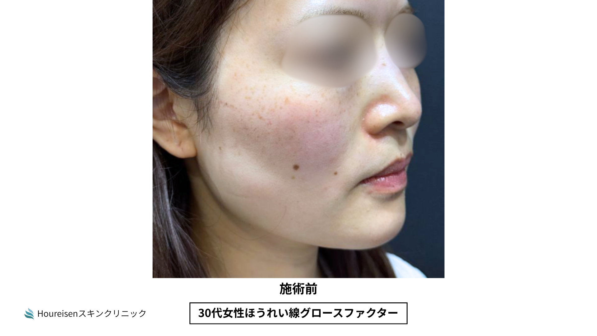 ほうれい線施術前