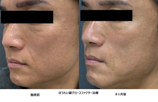 40代男性 症例15のほうれい線治療写真