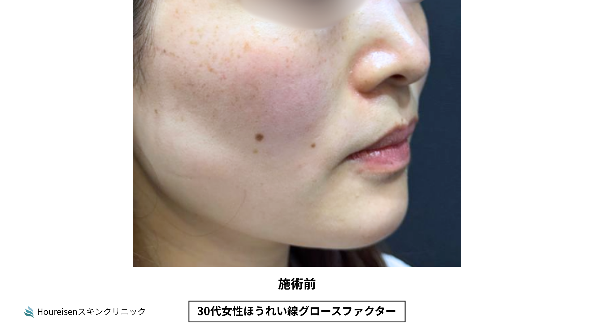 ほうれい線施術前