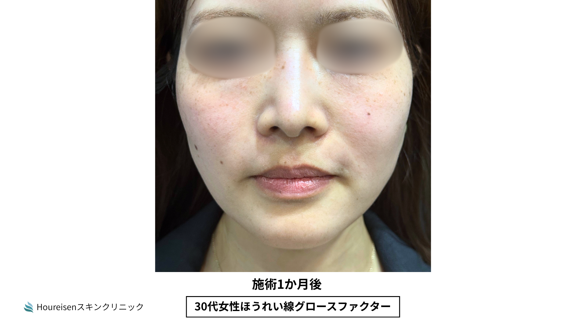ほうれい線施術1か月後