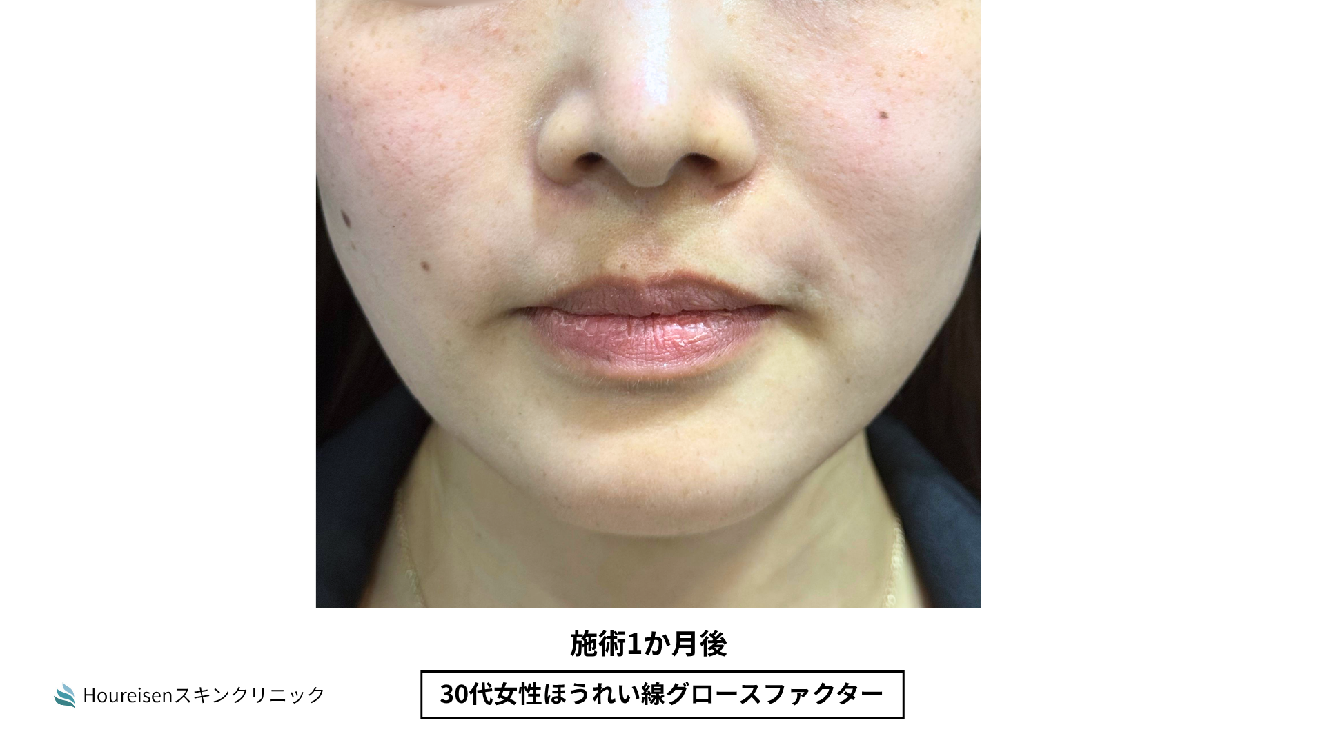 ほうれい線施術1か月後