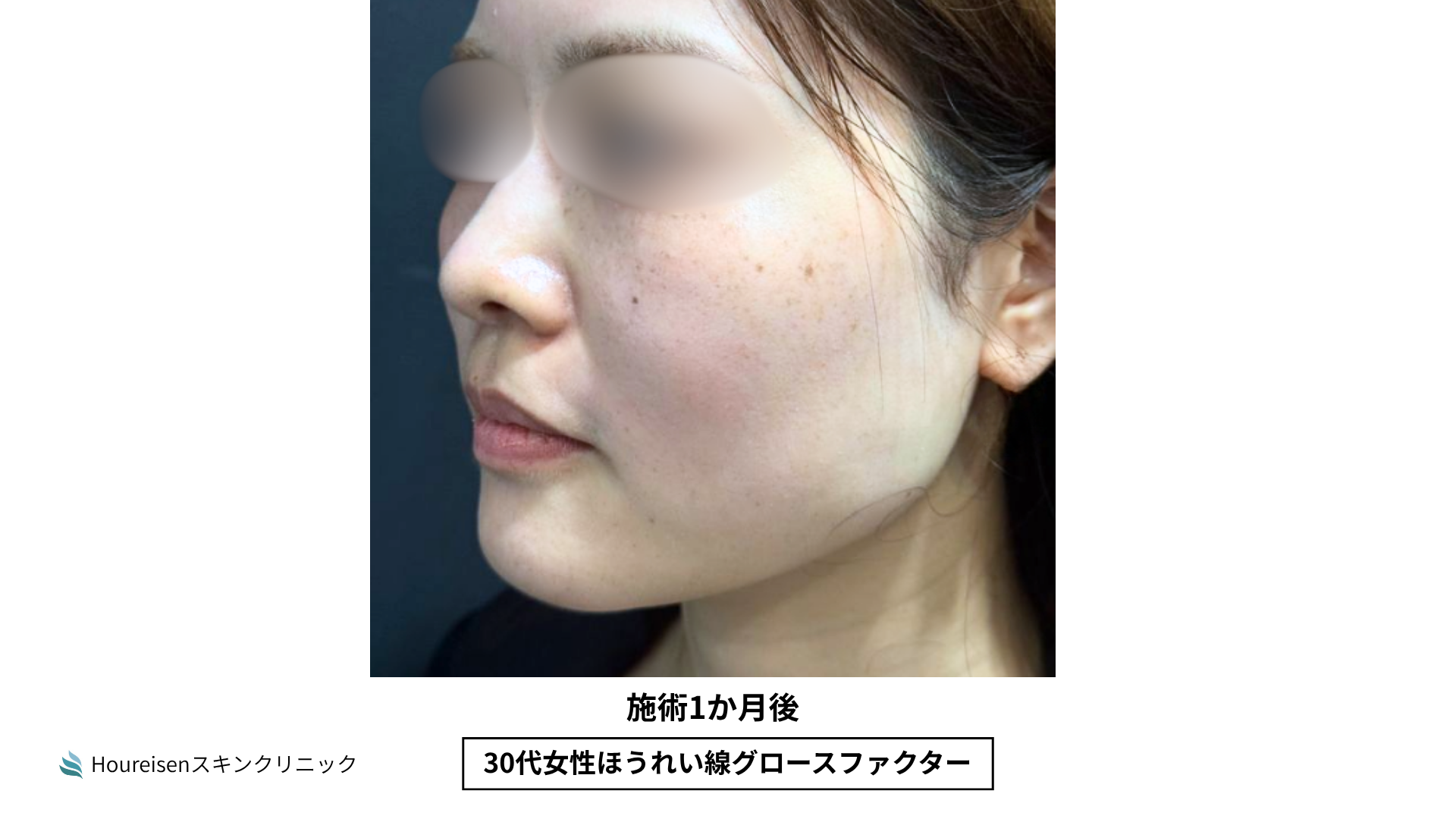 ほうれい線施術1か月後