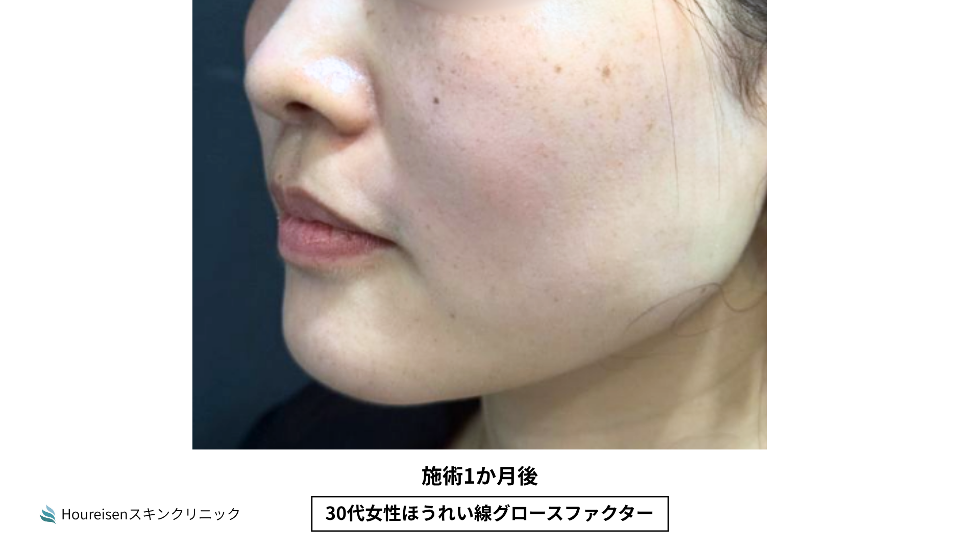 ほうれい線施術1か月後