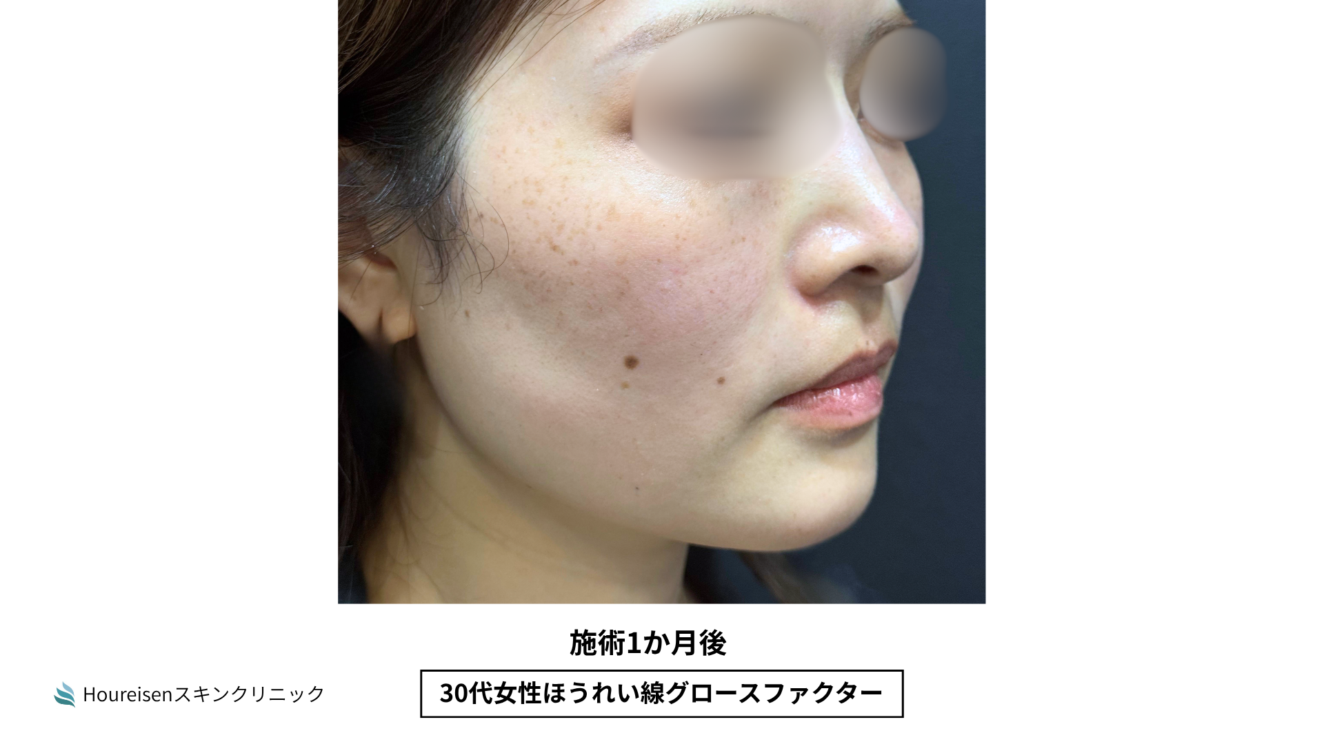 ほうれい線施術1か月後