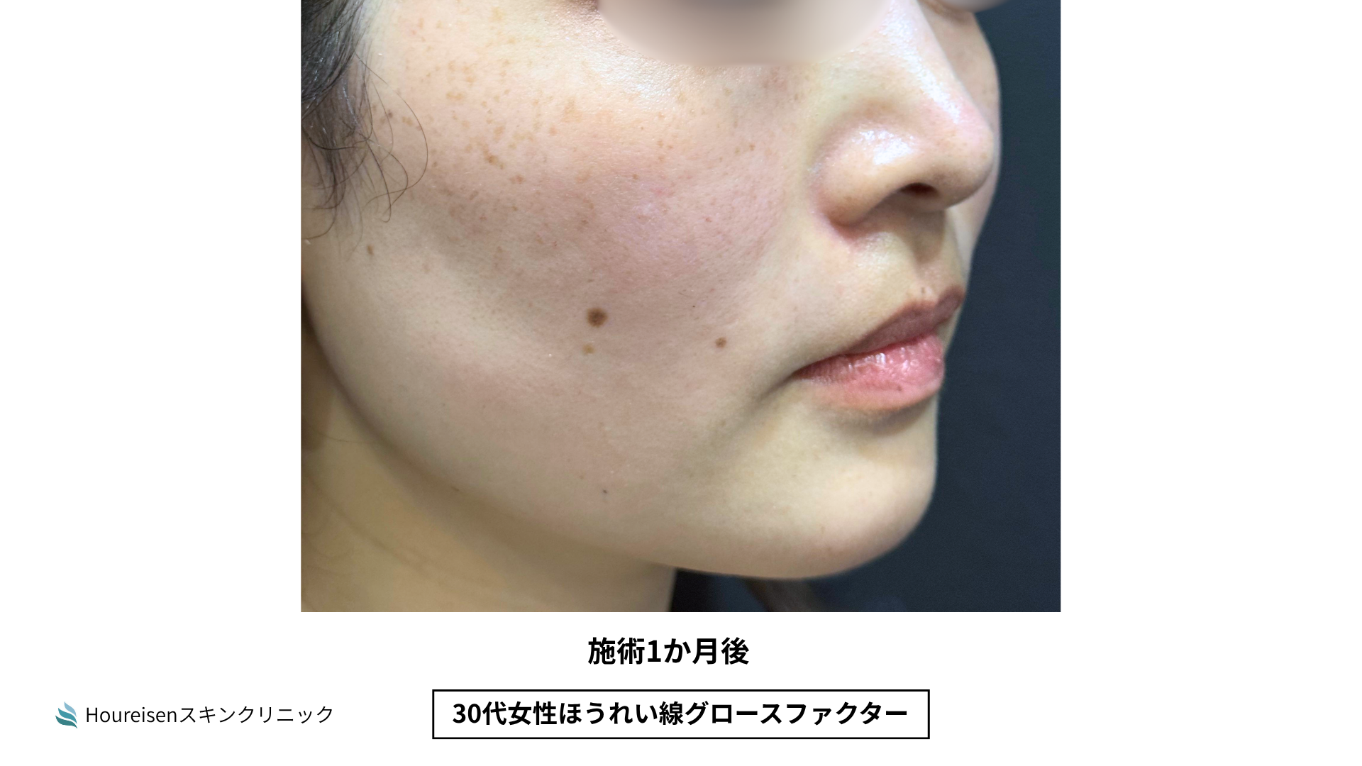 ほうれい線施術1か月後