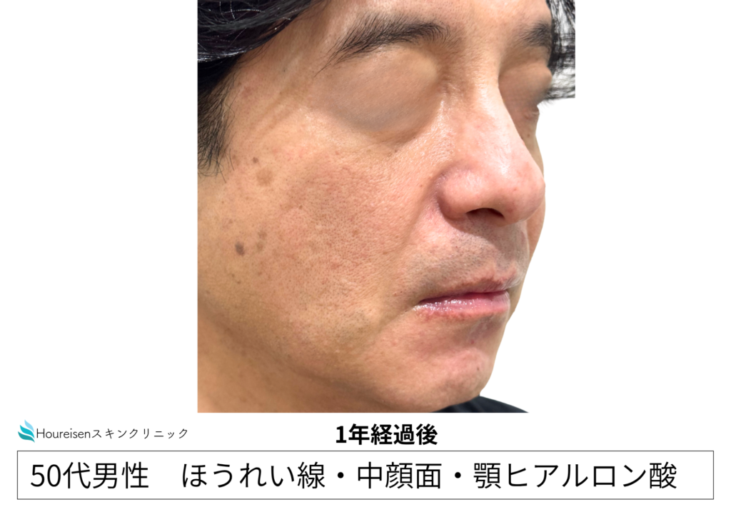 50代男性 ほうれい線ヒアルロン酸 追加注入症例