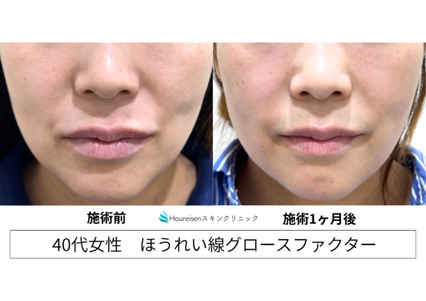40代女性 症例69のほうれい線治療写真