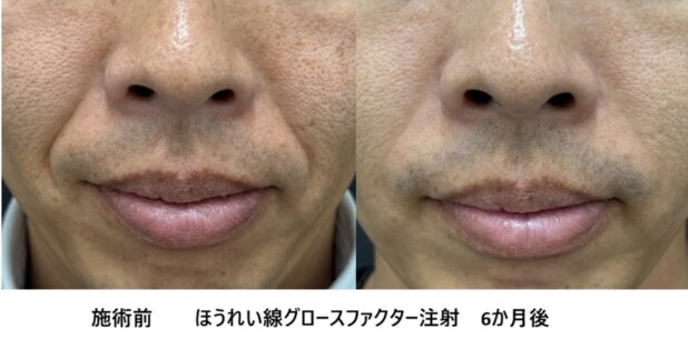 40代男性 症例16のほうれい線治療写真
