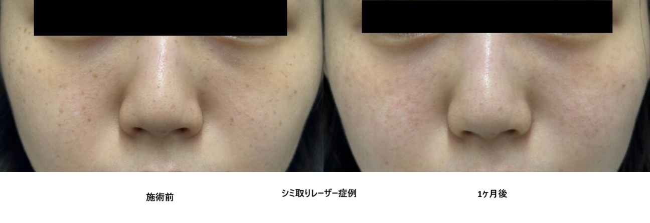 レーザーで全顔のシミ・そばかすを除去した症例⑪の症例写真