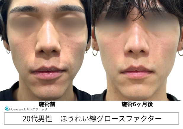 20代男性 症例5のほうれい線治療写真