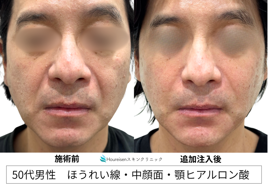 50代男性 ほうれい線ヒアルロン酸 初回治療前と追加注入後の比較