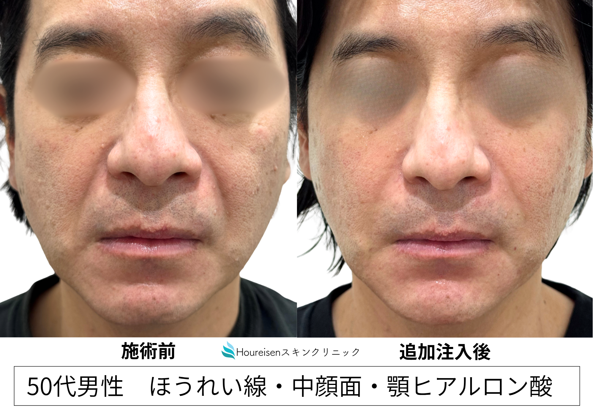 ヒアルロン酸注入治療後1年経過|追加注入を行った50代男性症例㊾の症例写真