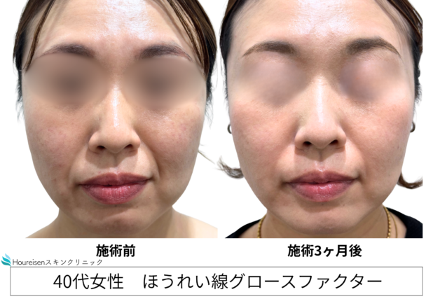 40代女性 症例67のほうれい線治療写真