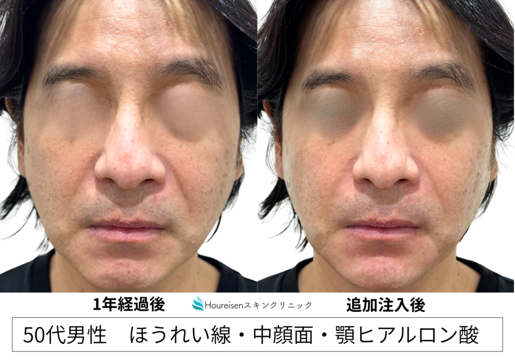 ヒアルロン酸追加注入前と追加注入後の比較
