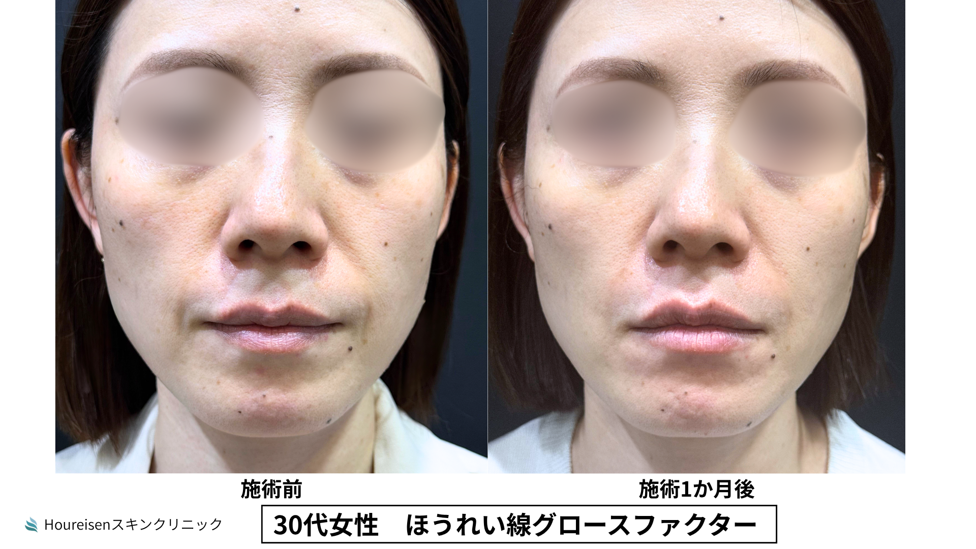 30代女性 ほうれい線グロースファクター治療前と1か月後