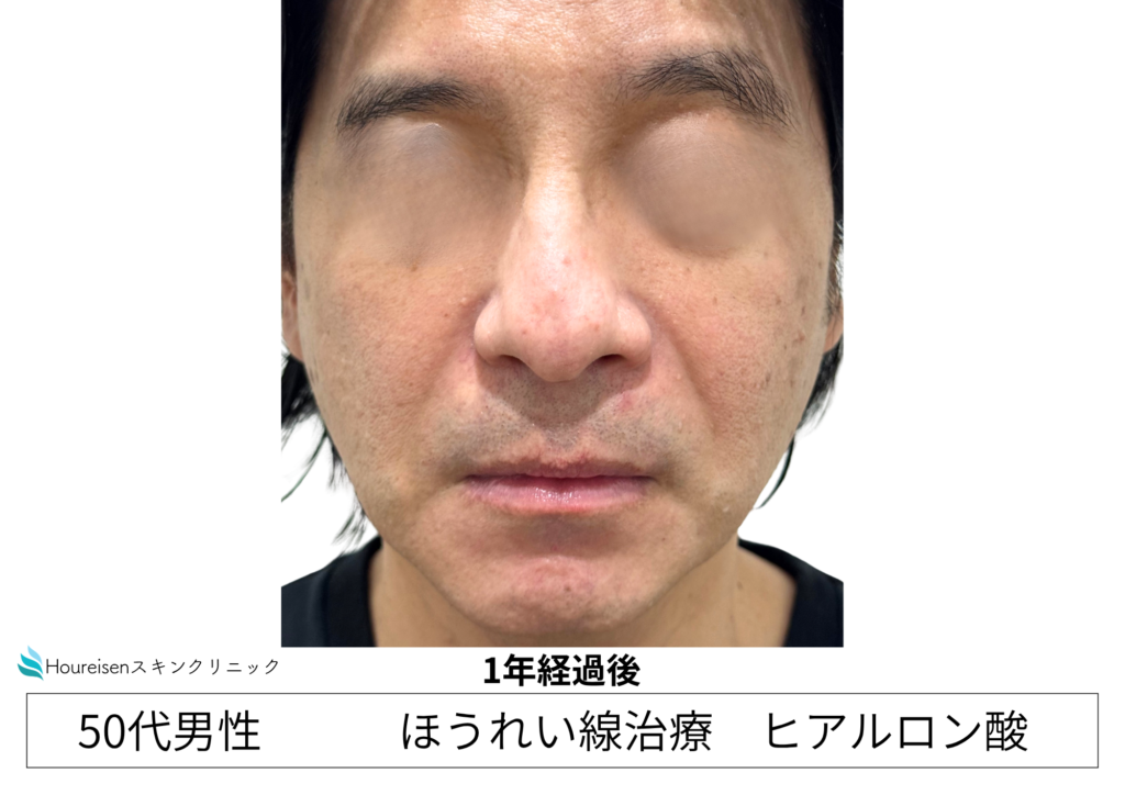 50代男性 ほうれい線ヒアルロン酸 2回目追加注入後