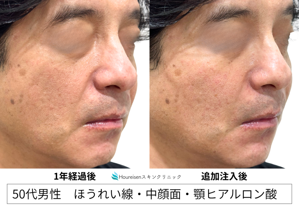 50代男性 ヒアルロン酸追加注入 症例写真