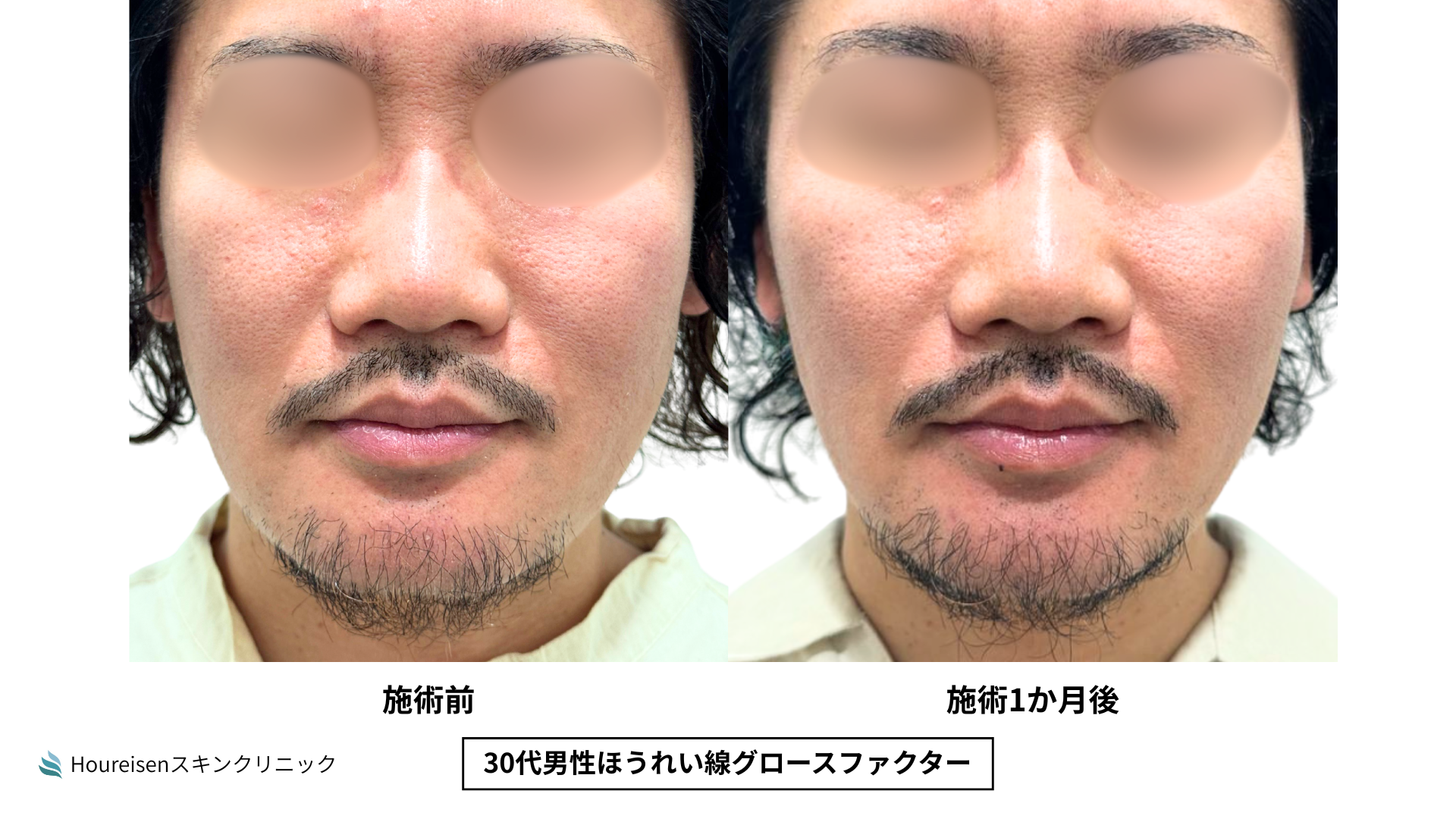 30代男性 症例16のほうれい線治療写真