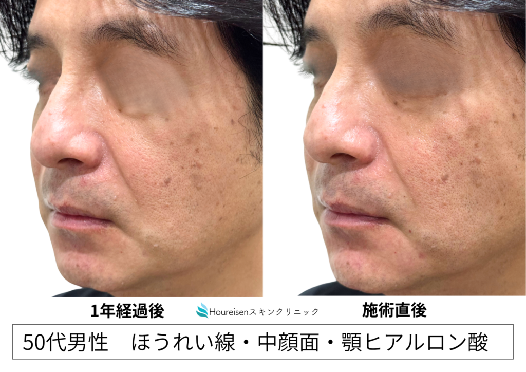 50代男性 ヒアルロン酸追加注入 横顔症例