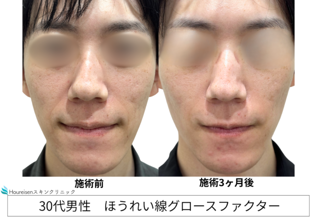30代男性 症例14のほうれい線治療写真