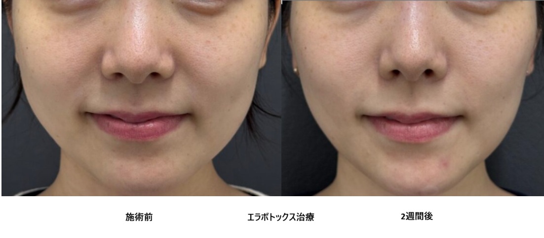 エラボトックスで小顔治療⑥｜歯ぎしり・食いしばりにも効果あり？の症例写真