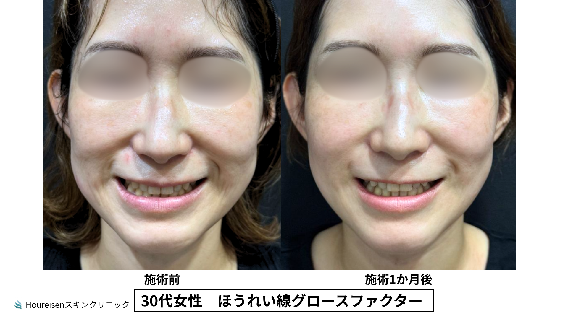 30代女性 ほうれい線グロースファクター施術前と3か月後