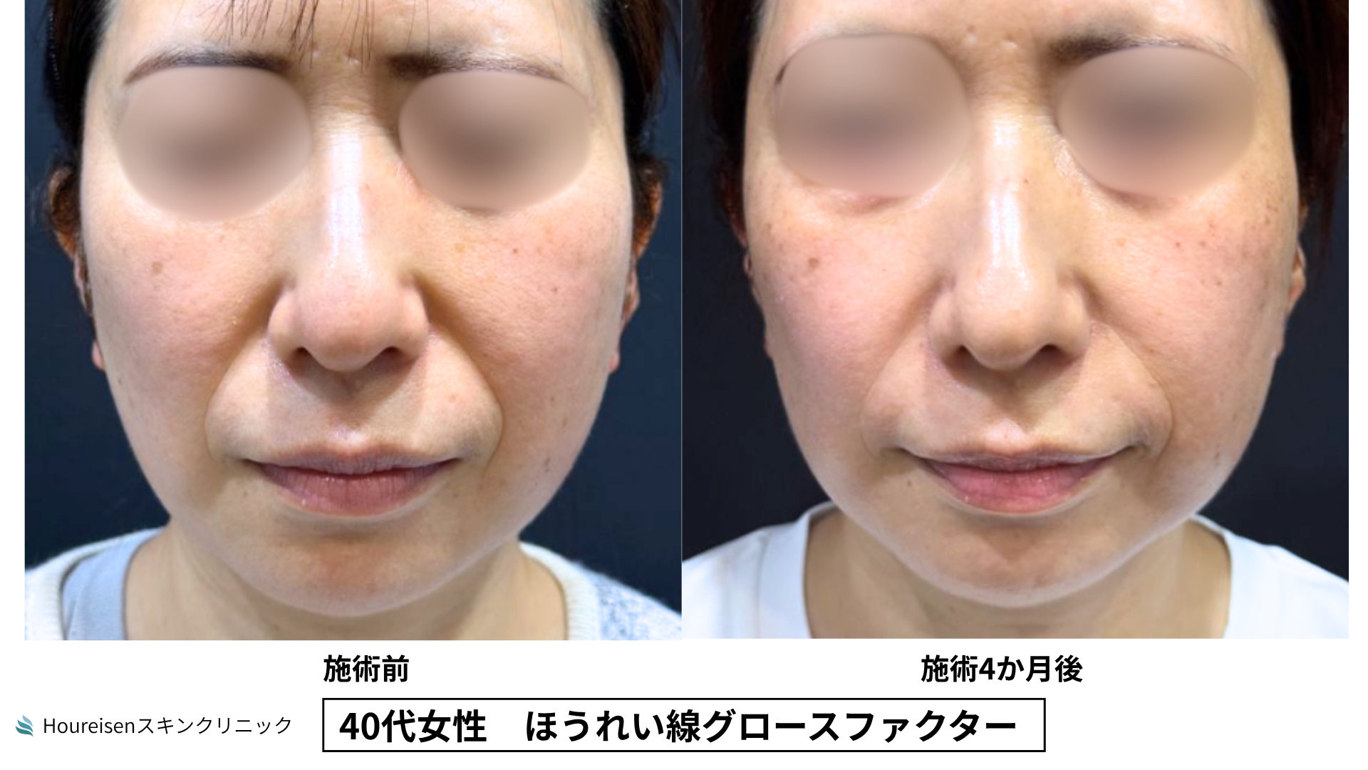 40代女性 ほうれい線グロースファクター施術前と4か月後