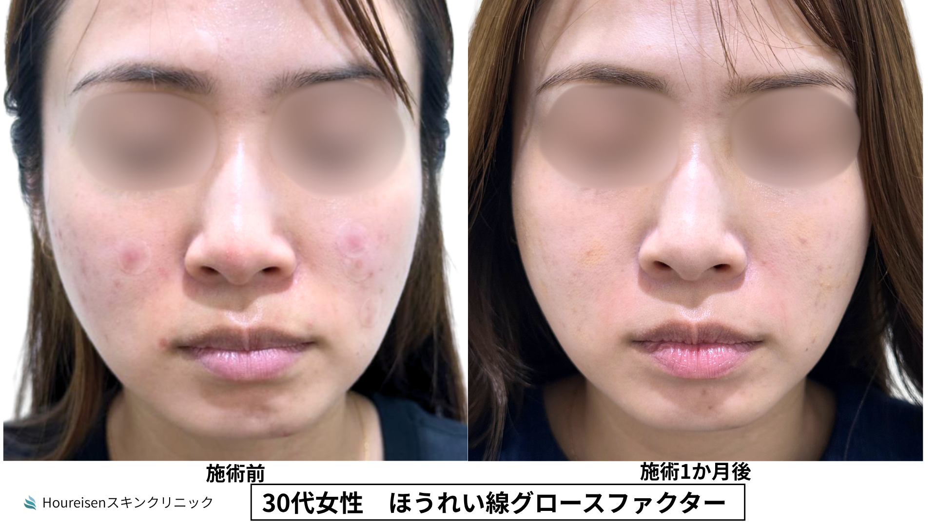 30代女性 ほうれい線グロースファクター施術前と1か月後