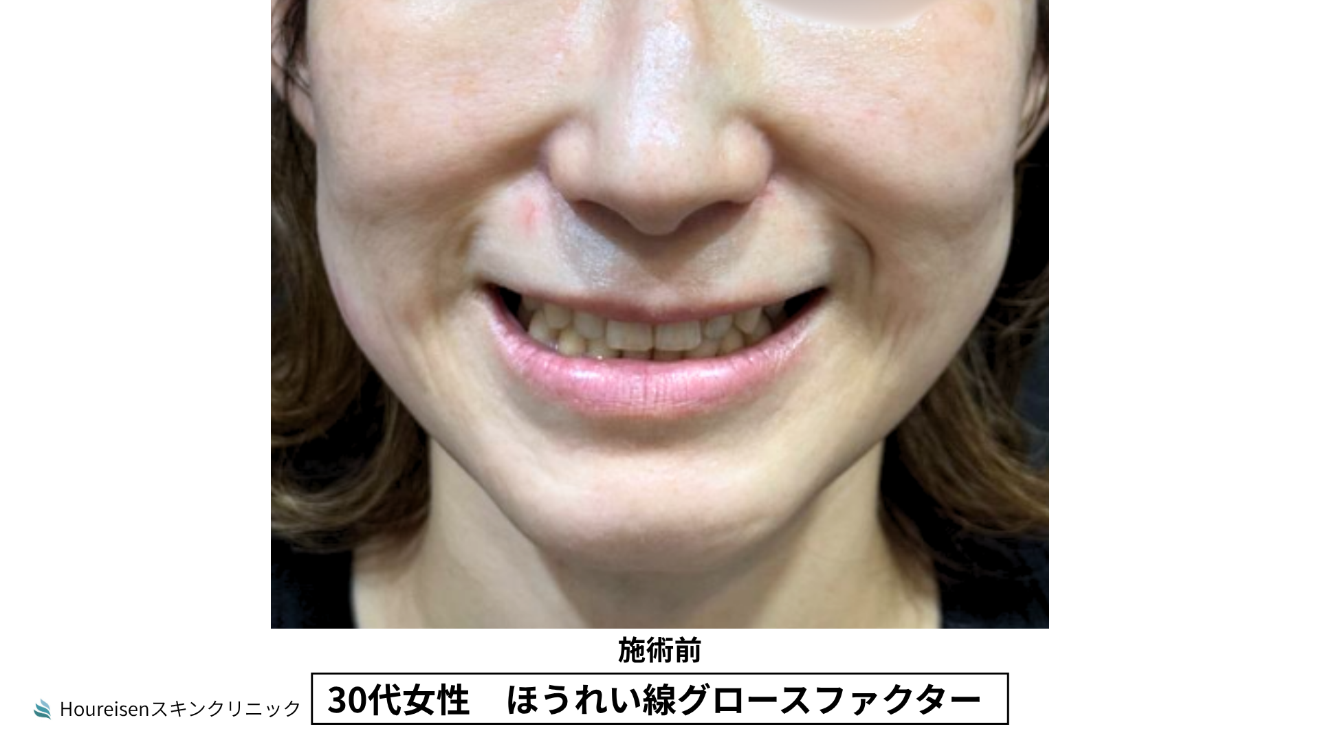 30代女性 ほうれい線グロースファクター施術前