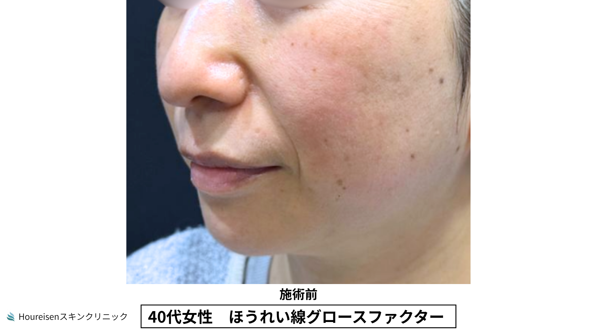 40代女性 ほうれい線グロースファクター施術前