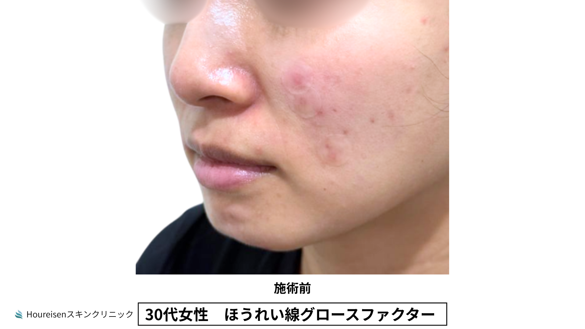 30代女性 ほうれい線グロースファクター施術前