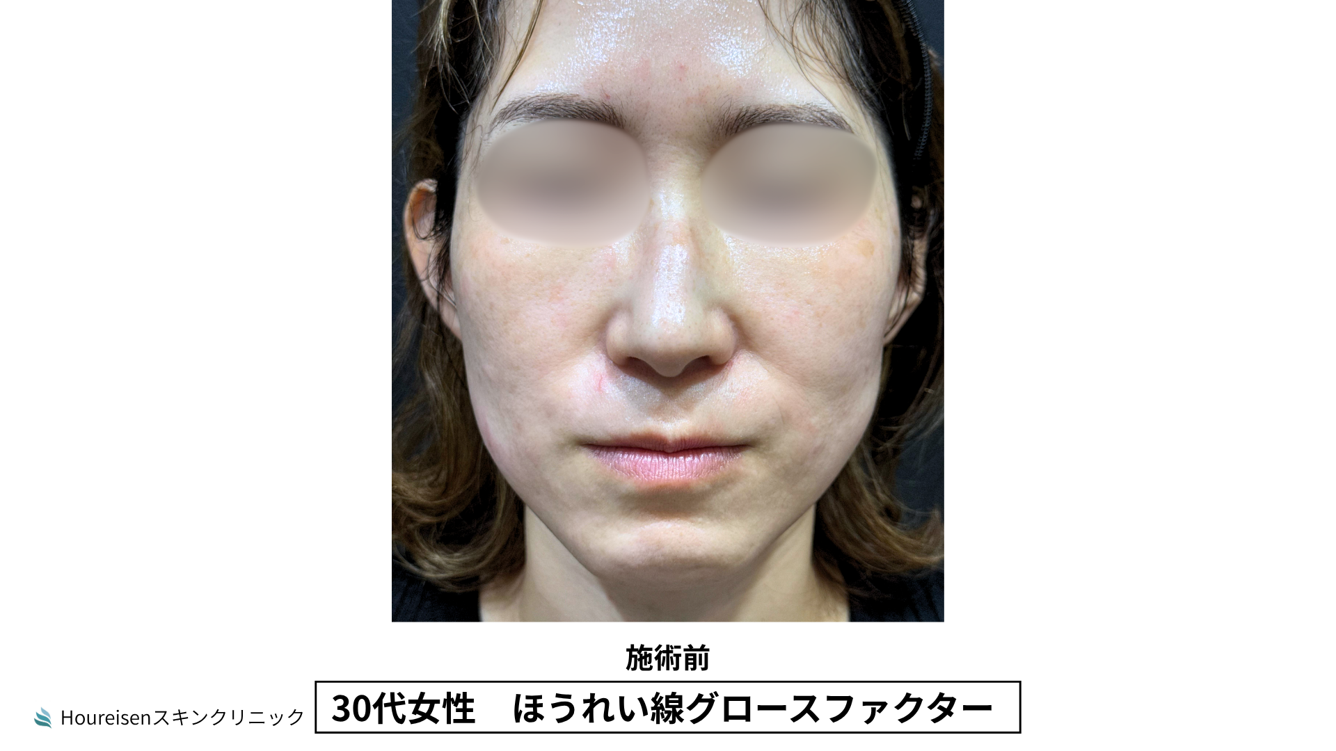 30代女性 ほうれい線グロースファクター施術前