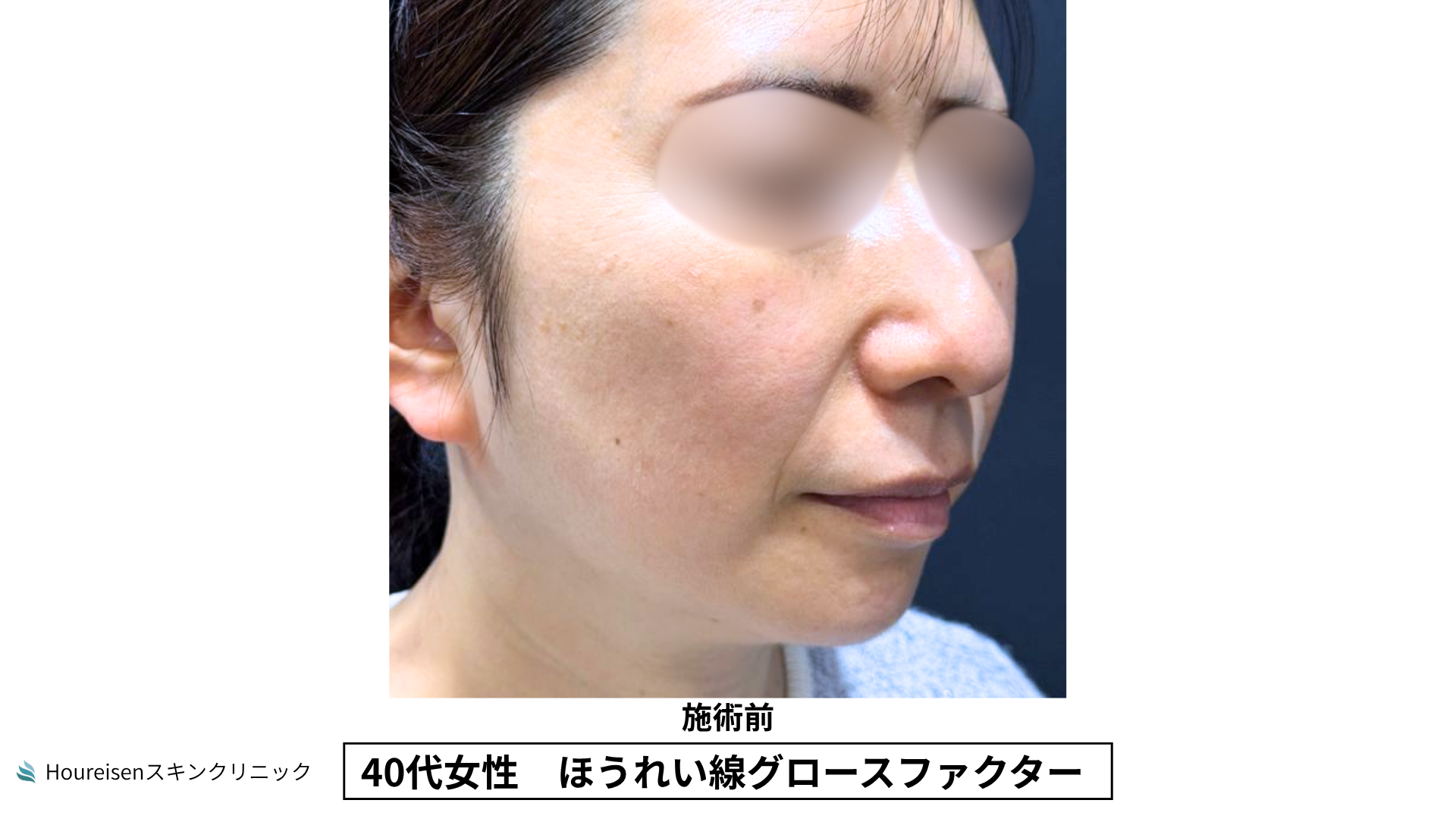 40代女性 ほうれい線グロースファクター施術前