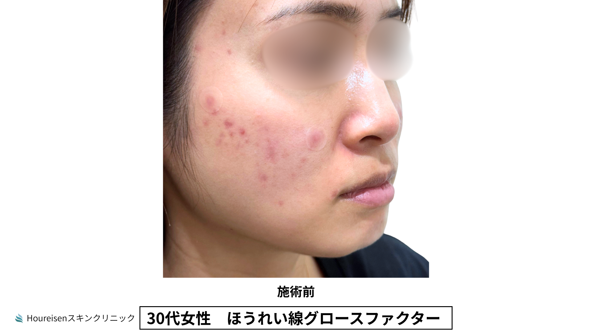 30代女性 ほうれい線グロースファクター施術前