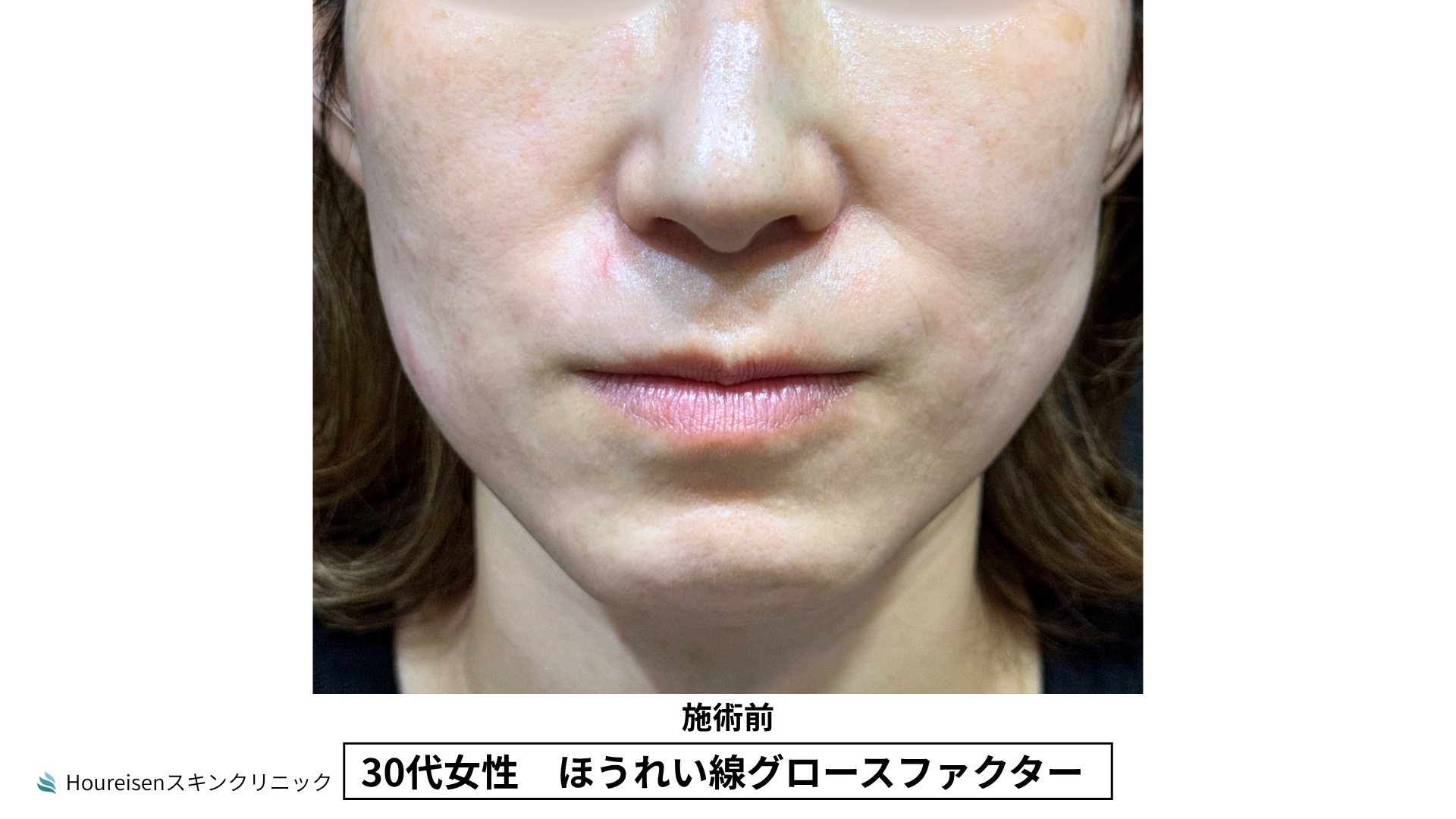 30代女性 ほうれい線グロースファクター施術前