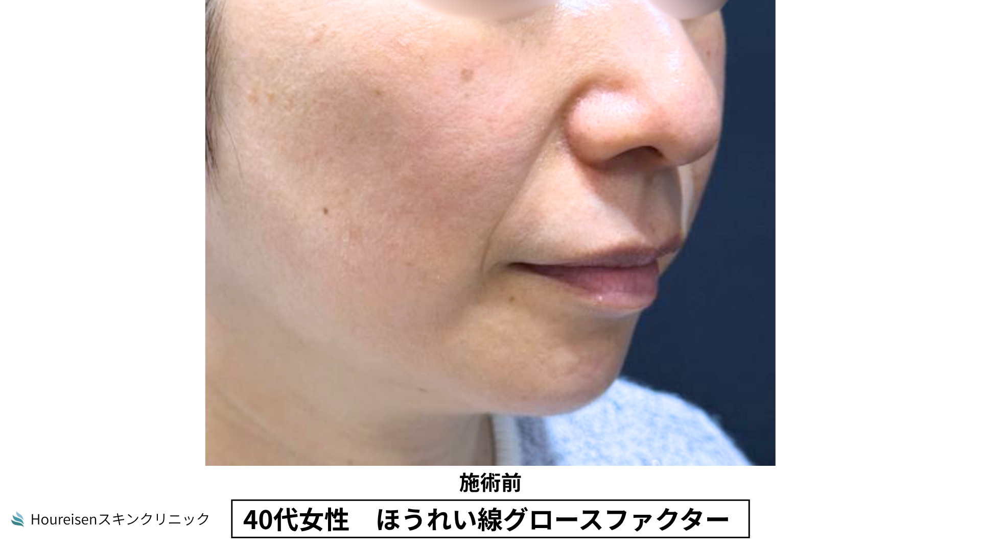 40代女性 ほうれい線グロースファクター施術前