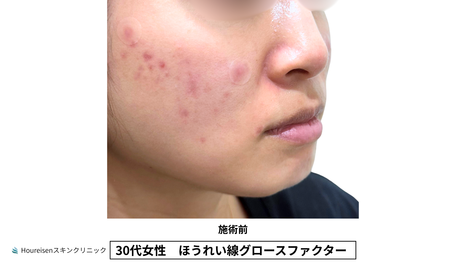 30代女性 ほうれい線グロースファクター施術前