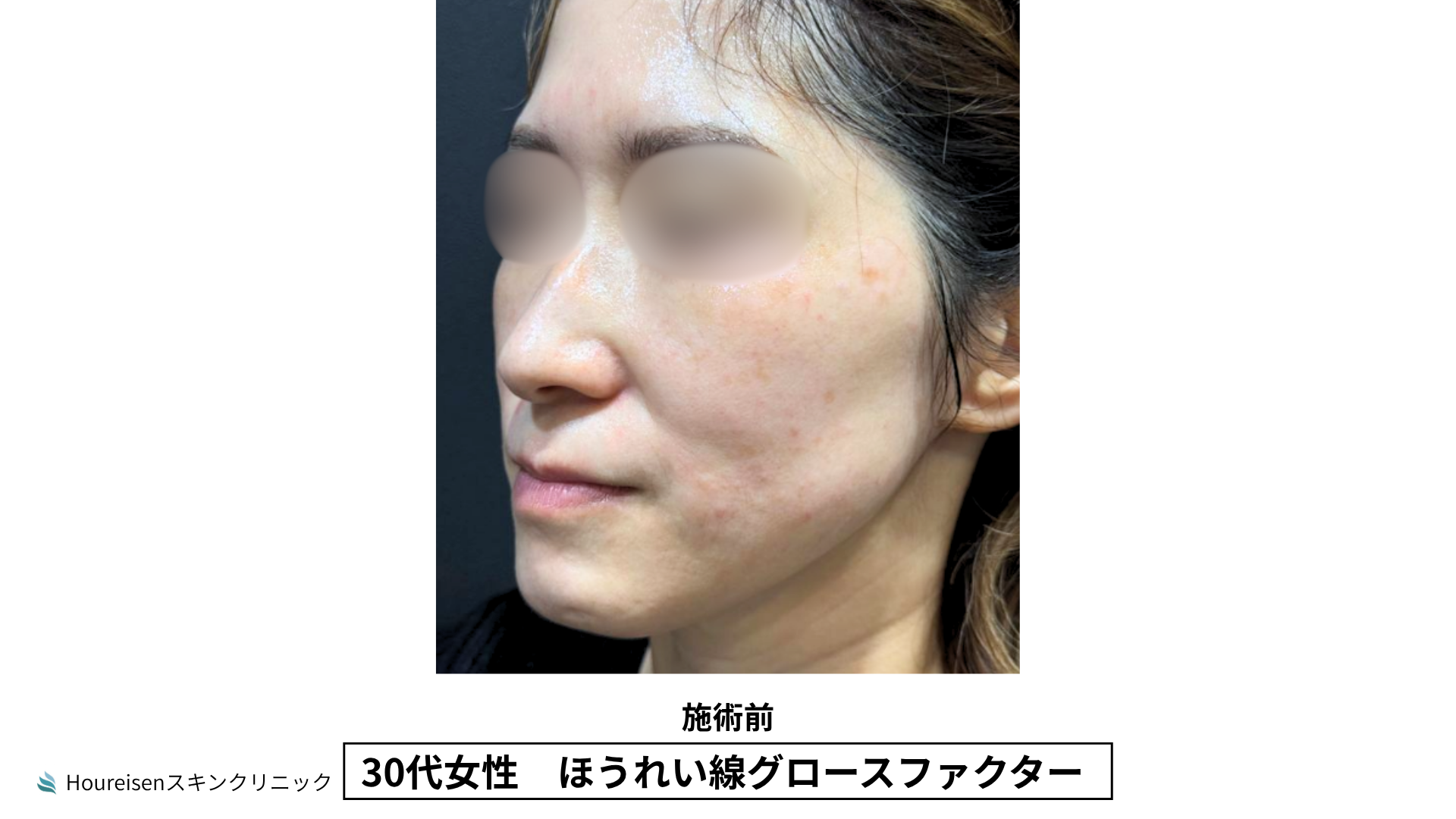30代女性 ほうれい線グロースファクター施術前