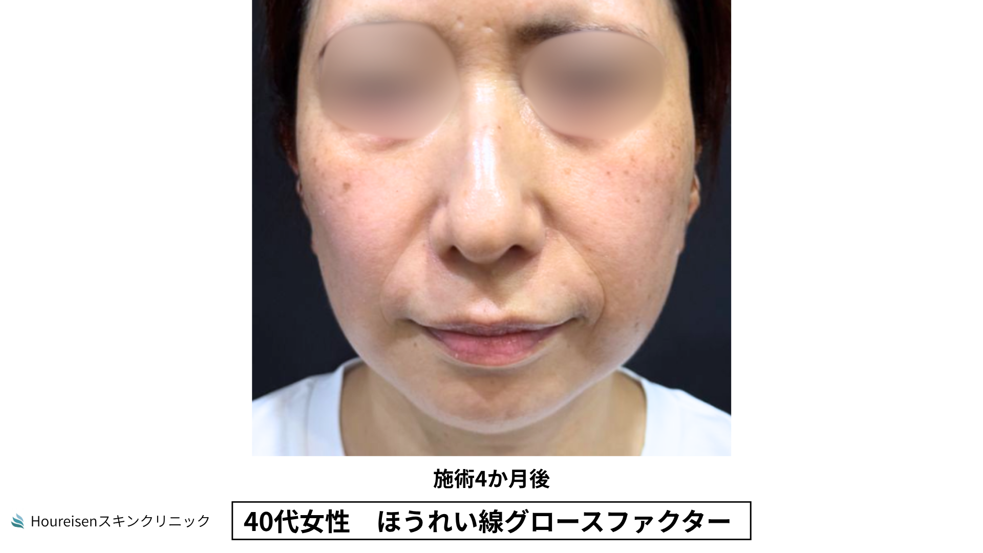 40代女性 ほうれい線グロースファクター施術4か月後