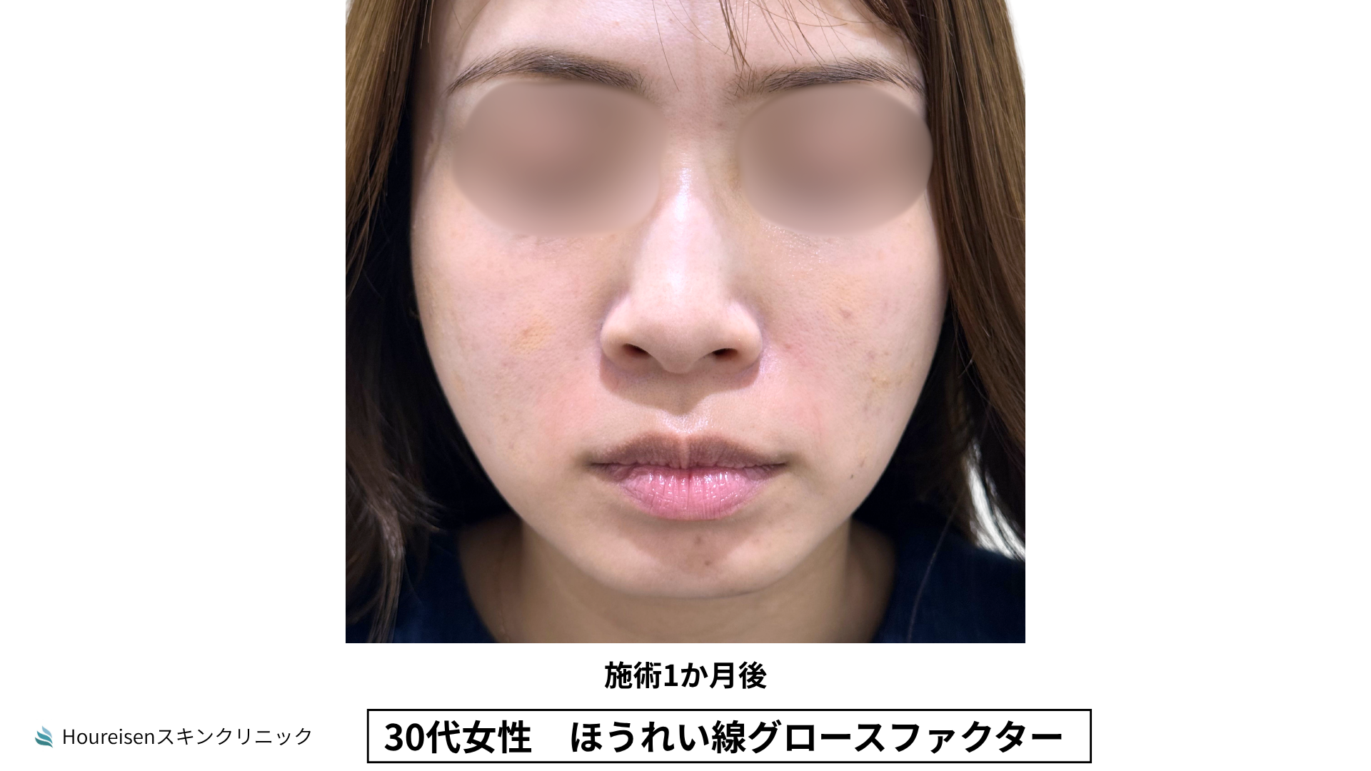 30代女性 ほうれい線グロースファクター施術1か月後