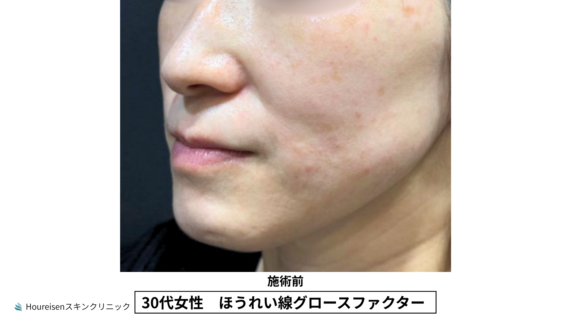 30代女性 ほうれい線グロースファクター施術前