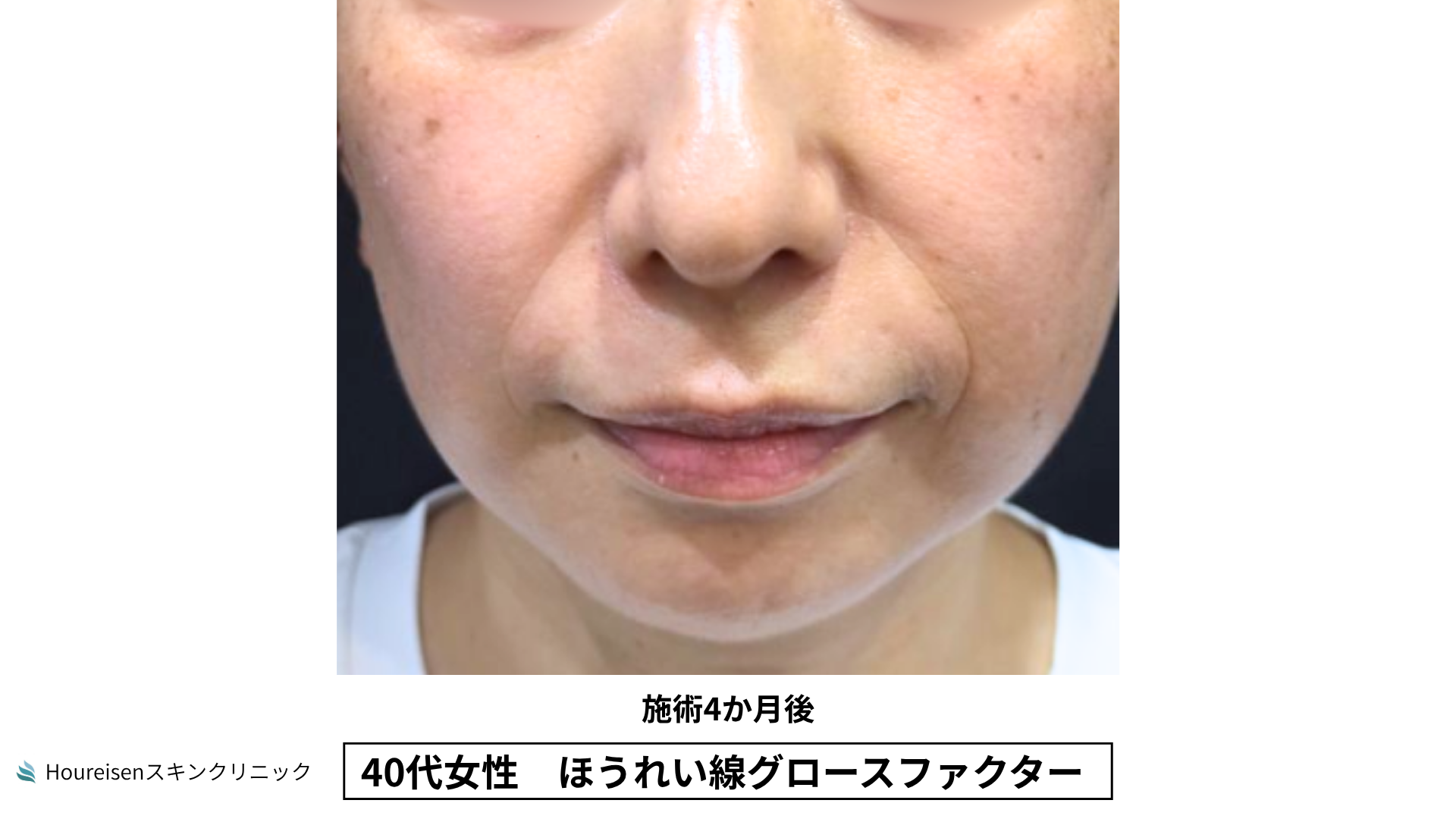 40代女性 ほうれい線グロースファクター施術4か月後