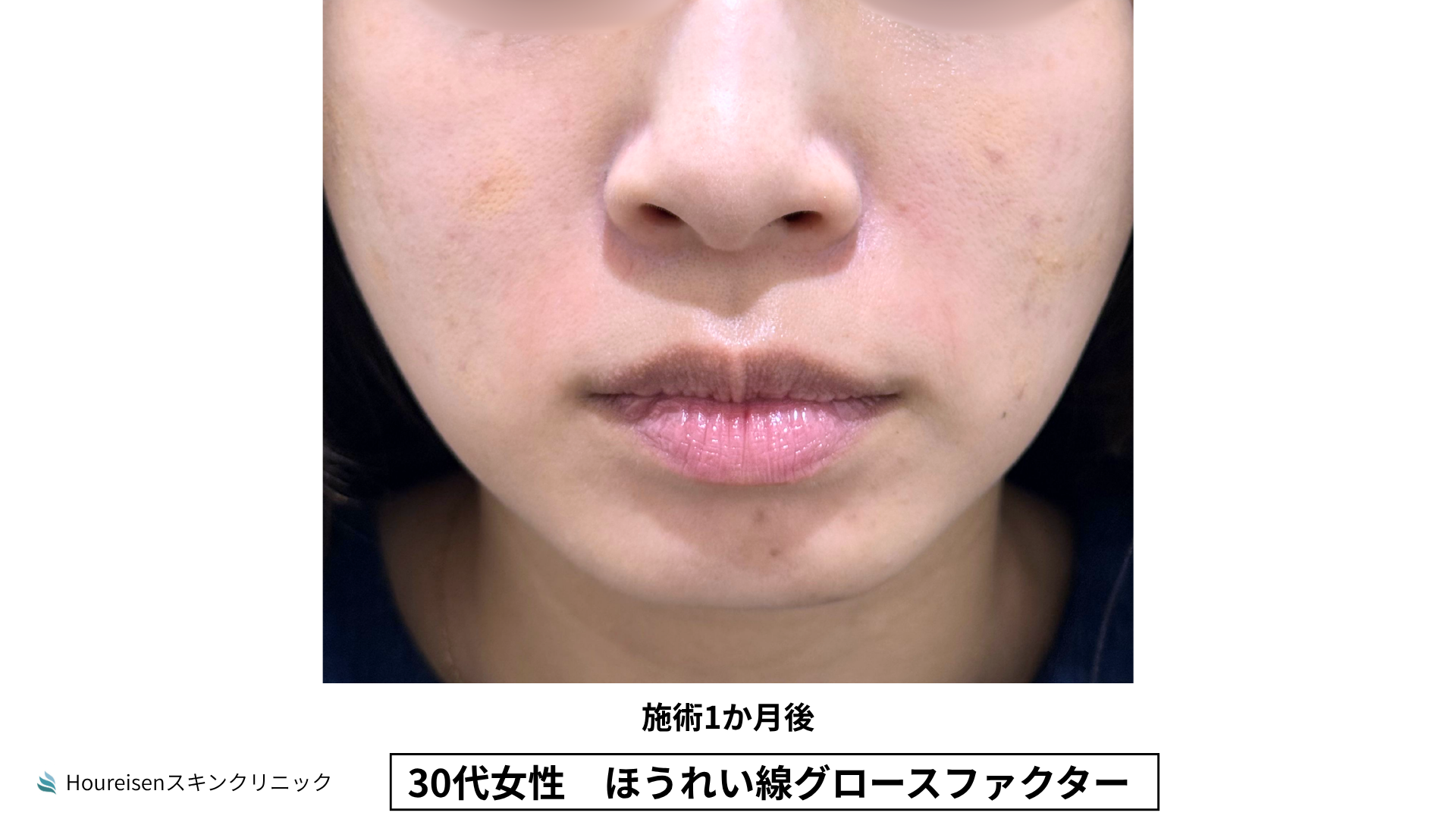 30代女性 ほうれい線グロースファクター施術1か月後