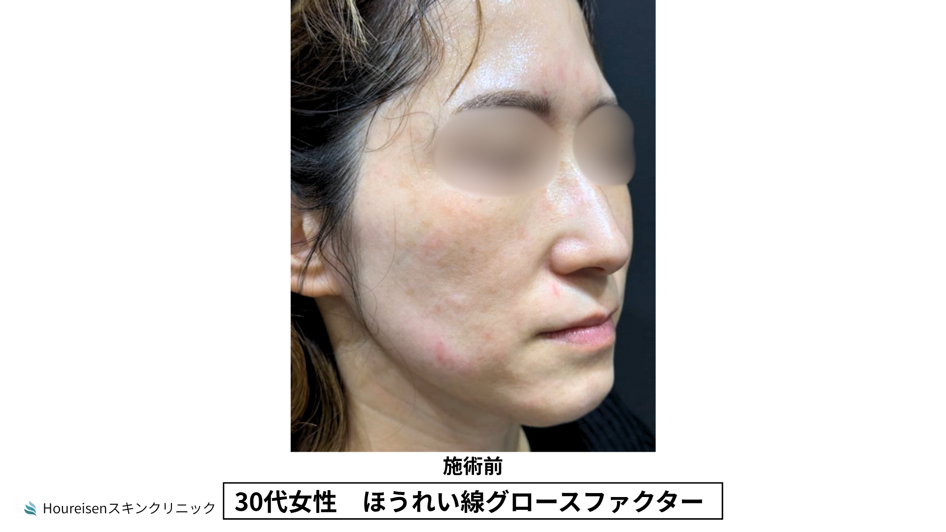 30代女性 ほうれい線グロースファクター施術前