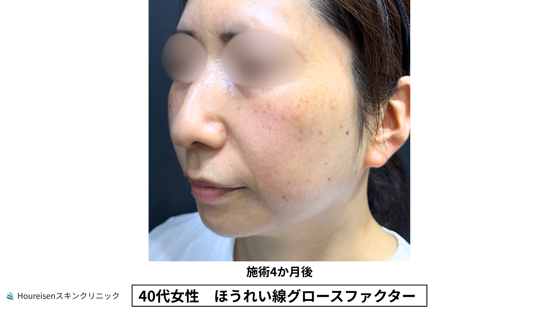40代女性 ほうれい線グロースファクター施術4か月後